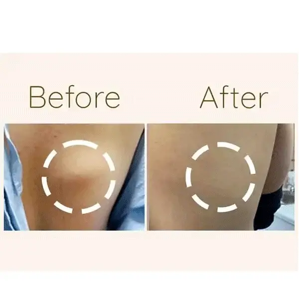 Before and after comparison of arm lipoma showing reduction of a rounded fatty lump highlighted with a circle.