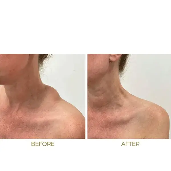 Before and after comparison showing reduction of a neck lump or lipoma near the collarbone area.