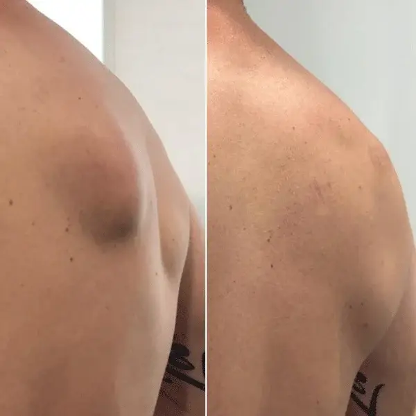 Before and after lipoma treatment on shoulder showing reduction in fatty lump and smoother skin