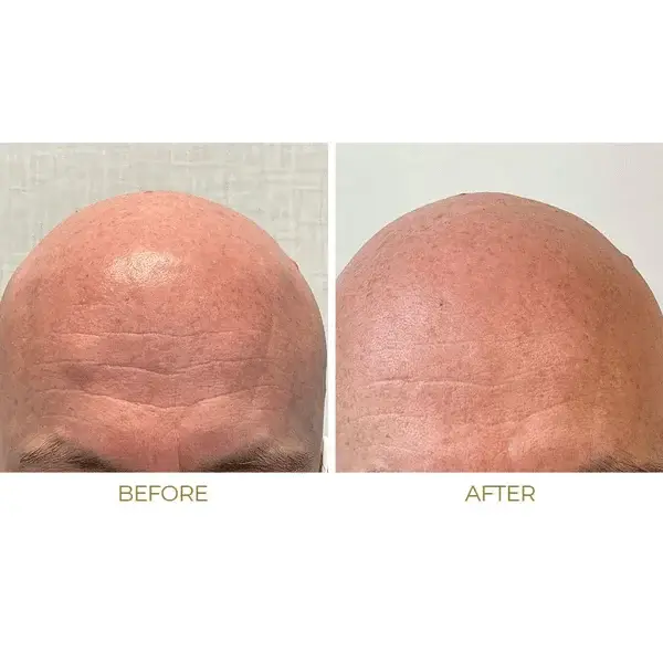 Before and after lipoma treatment on forehead showing reduced swelling and smoother skin texture