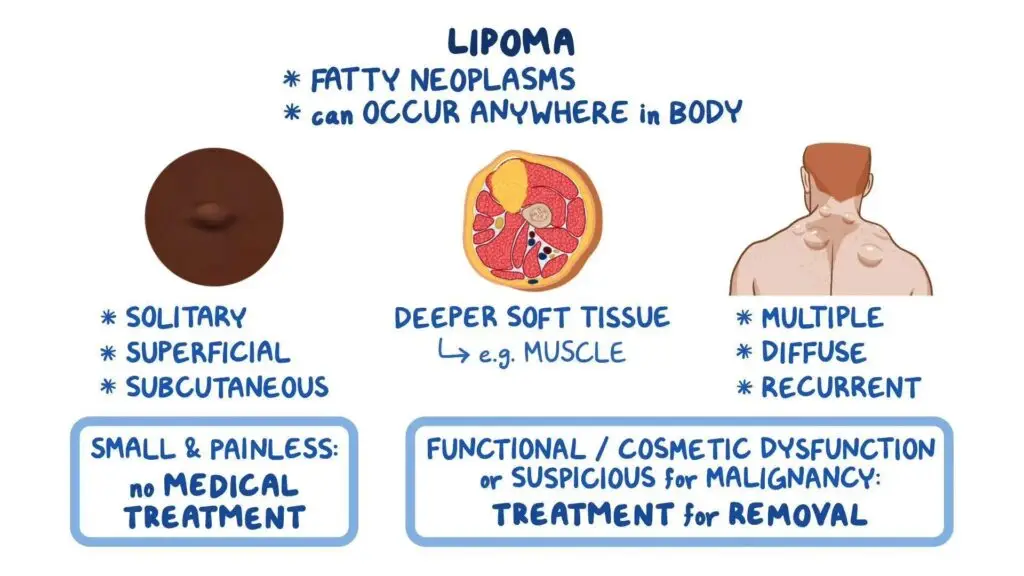 Lipoma Causes
