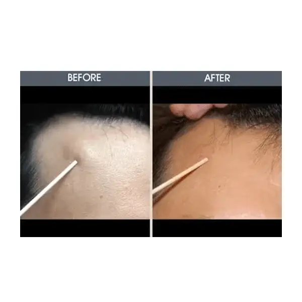 Before and after comparison of a forehead lipoma showing visible reduction of a small lump near the hairline.