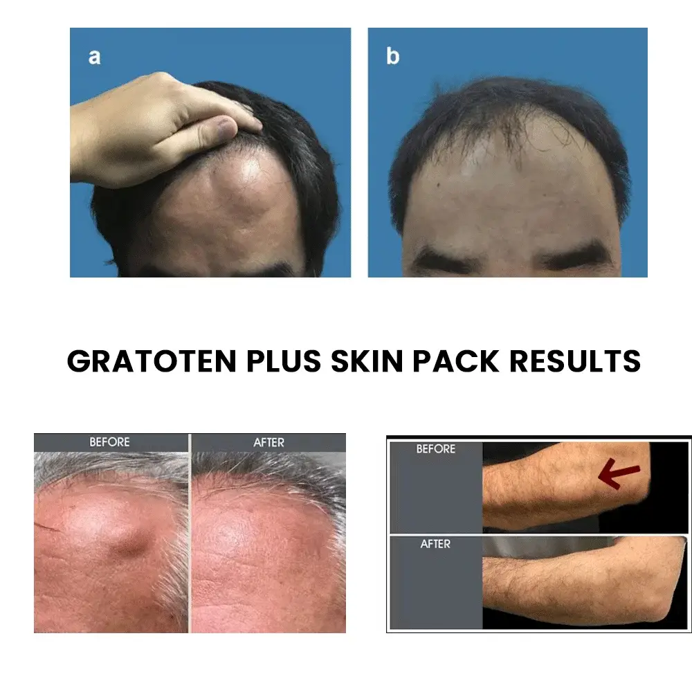 Before and after images showing reduction of lipomas on the forehead, arm, and scalp after treatment with Gratoten Plus Skin Pack.