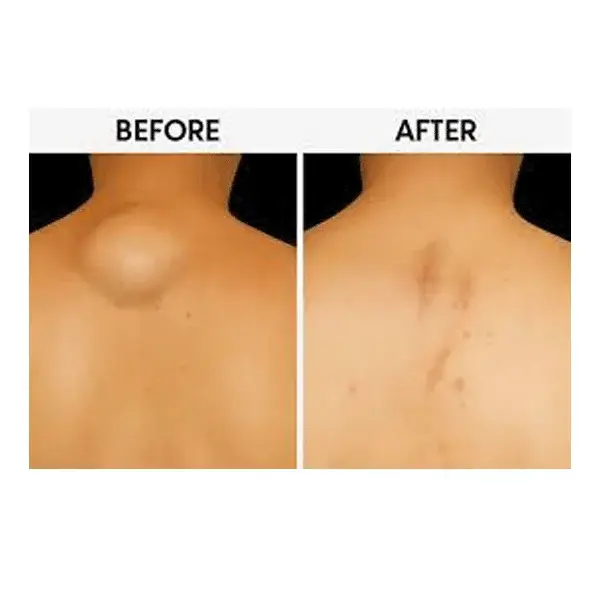 Before and after comparison of a large upper back lipoma showing removal and smoother skin appearance.