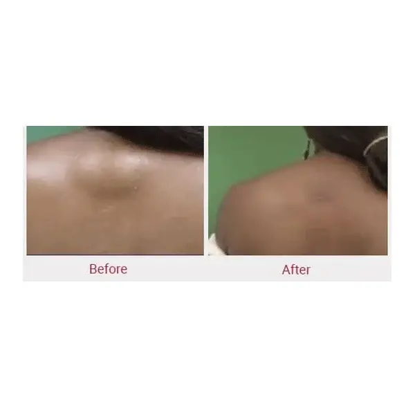 Before and after comparison of a shoulder lipoma showing reduction in a raised fatty lump.