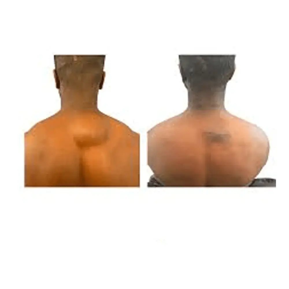 Before and after comparison of upper back lipoma showing reduction of a central fatty lump near the spine.