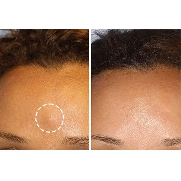 Before and after lipoma treatment on forehead showing visible reduction in fatty lump size